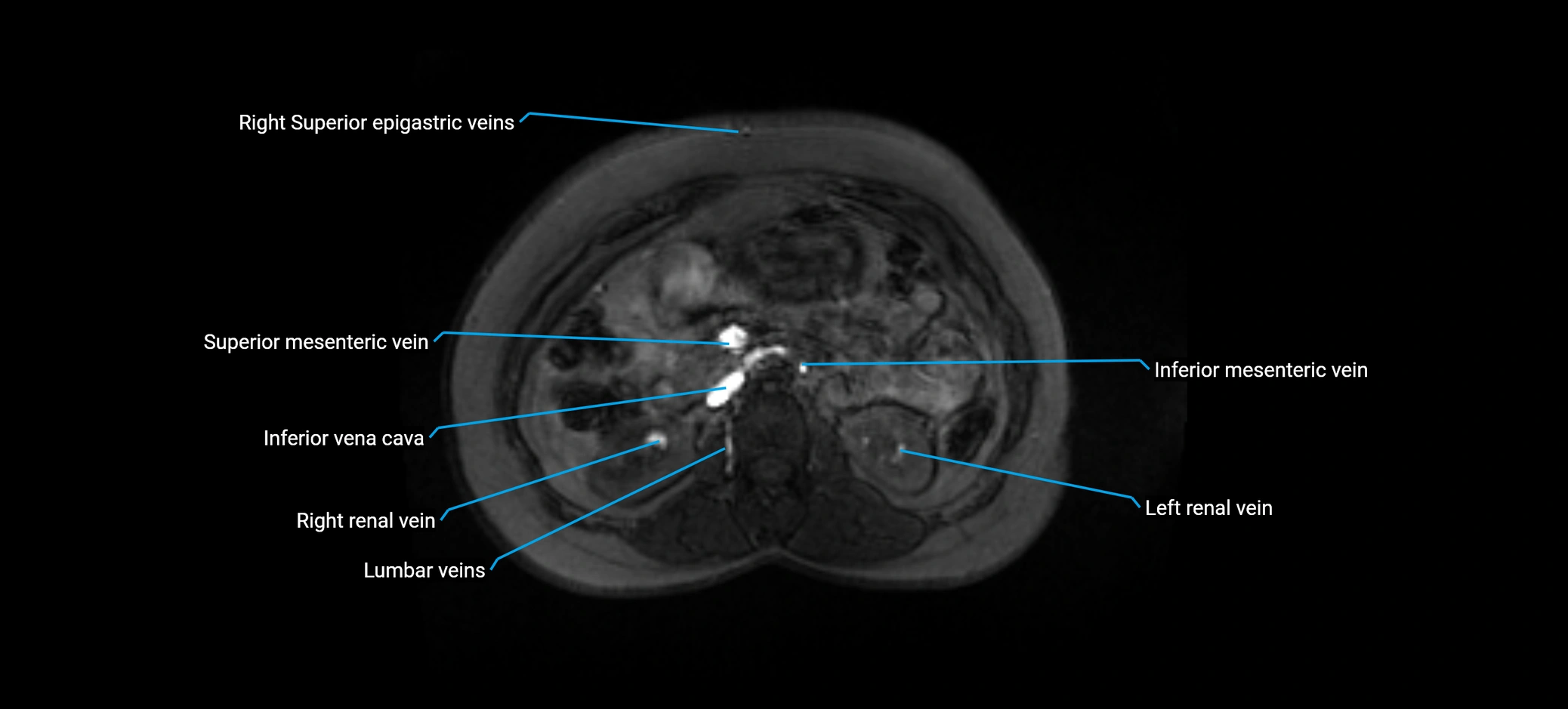 MRV abdomen pelvis & lower limb axial cross sectional anatomy labelled MRI image 73 (1).webp